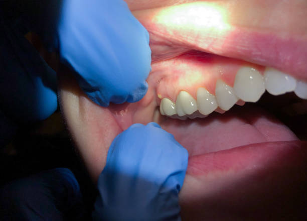 Best Emergency Dentist for Lost Fillings or Crowns in Arlington, NY